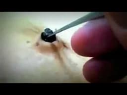 50 Second Satisfaction Navel Stone Extraction like MASSIVE BLACKHEAD