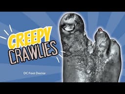 Creepy Crawlies: Saving A Diabetic Foot