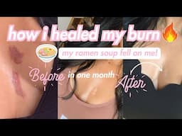 How I Healed my Burn in a MONTH with No Scars! I burned myself with Ramen 🍜 | Roxy James #burn