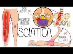 Sciatica Explained (Including Red Flag Symptoms)