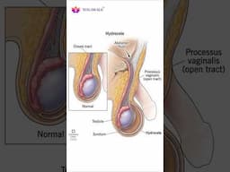 हाइड्रोसील ठीक करें बिना ऑपरेशन के | Yoga for Hydrocele Problem | Exercise | @Shorts #ytshort