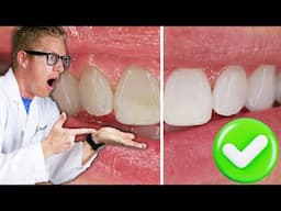 Dentist Reveals The BEST Teeth Whitening Results with Research! Overnight Carbamide Peroxide Gel Kit