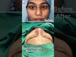 Rhinoplasty In Bangalore Chandigarh Hyderabad Lucknow Kolkata Raipur Nagpur Surat Ahmedabad Delhi