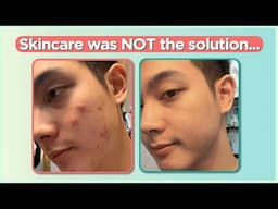 Confused sa pag treat ng ACNE? Start here! (Beginners' Guide) | Jan Angelo