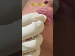 Lip Filler Treatment ✨