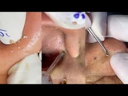 10 Minutes Of Top ASMR Pimple Popping Video