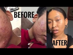 HOW I CLEARED MY TERRIBLE ACNE // HELPING YOU CLEAR YOURS