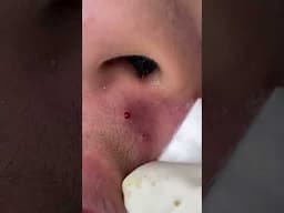 Big Cystic Acne Blackheads Extraction Blackheads & Milia, Whiteheads Removal Pimple Popping #shorts