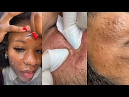 9 Minutes Of Top ASMR Pimple Popping Video