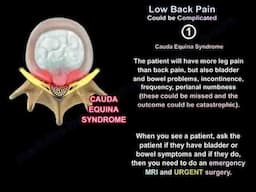 Understanding Complicated Low Back Pain: Causes, Symptoms, and Treatment Options