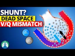 Shunt vs. Dead Space vs. V/Q Mismatch | EXPLAINED