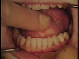 SURGICAL EXCISION OF EPIDERMOID CYST FROM FLOOR OF MOUTH