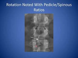 How to Read a Lumbar Spine X-ray | Reading Standing Spine X-ray