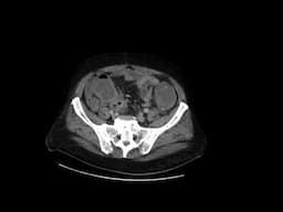 Sigmoid cancer with cecal perforation