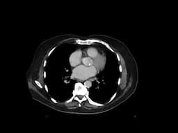 IgG4 related disease