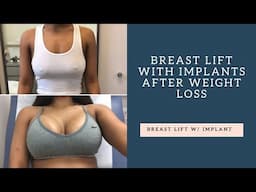 MY PLASTIC SURGERY EXPERIENCE - BREAST LIFT WITH IMPLANT | Jaz Jackson