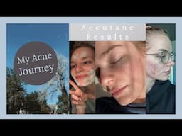 Accutane RESULTS // 20-40mg LOW DOSE