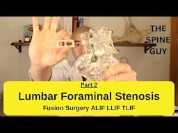 Lumbar Foraminal Stenosis - Fusion Surgery Options Part 2