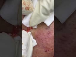 Big Cystic Acne Blackheads Extraction Blackheads & Milia, Whiteheads Removal Pimple Popping #shorts