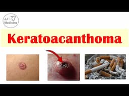 Keratoacanthoma (Rapidly Growing Skin Lesion) | Risk Factors, Stages, Symptoms, Diagnosis, Treatment