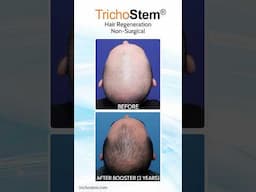 Other ACell+PRP Vs. TrichoStem Hair Regeneration: Cost, and Treatment Frequency #hairloss