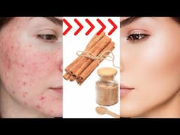 how to remove pimples overnight | acne treatment | remove acne pimples fast easy & effective!!!