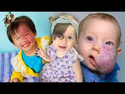 Babies born with Bizarre Facial Birthmarks and then miracles happened to them