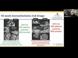 Management Guidance for Monochorionic Twin Pregnancies Webinar