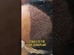 Female Patient ICE FUE Hair Transplant