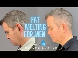 How to Get a Defined Jawline: Male Double Chin Removal with Endolift by Dr Nina Bal