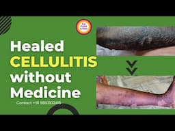 A 75 year old man healed Cellulitis on Fruit Diet