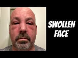 Swollen Face - Cancer Update