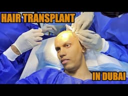 HAIR TRANSPLANT IN DUBAI ! IS IT PAIN FREE AND SAFE !??