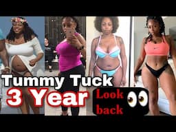 Tummy Tuck 3 Year Anniversary LOOKBACK with before and afters