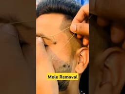 How to remove a mole? #moles #moleremoval #shorts #drniveditadadu