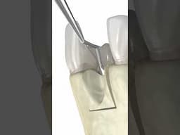 Dental bone graft: 3d animation #medicalanimation #dentalprocedure