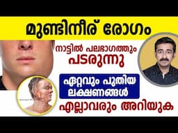 മുണ്ടിനീര് രോഗം പലയിടത്തും പടരുന്നു. ഏറ്റവും പുതിയ ലക്ഷണങ്ങൾ ഇതാണ്.. ശ്രദ്ധിക്കുക. സൂക്ഷിക്കുക