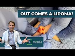 Out Comes A LIPOMA! | Dr. Derm