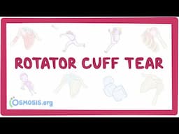 Rotator cuff tear