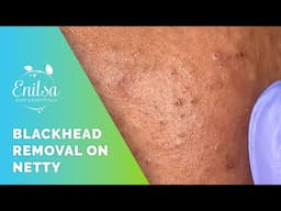 Blackhead Extractions on Netty - 9th Treatment