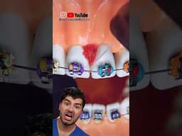 Braces Flossing Hack