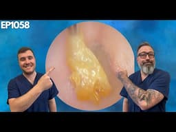 EXCESS SKIN REMOVALS FROM PATIENTS EAR CANALS - EP1058