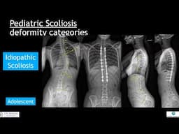 Non-AIS Scoliosis: What's the difference?