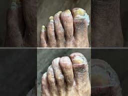 Fungal toenails #feet #podiatry #footcare #fungaltoenails