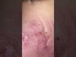 Big Cystic Acne Blackheads Extraction Blackheads & Milia, Whiteheads Removal Pimple Popping #shorts