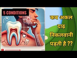 5 Conditions of wisdom tooth removal..कब अकल दाढ़ निकलवाना पड़ेगा?