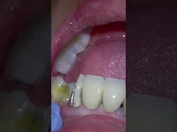 MAKING A FRONT DENTAL BRIDGE WITH 8 TEETH!!! REMOVING AN OLD BRIDGE #Dentistry #dentalbridge