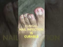 Fungal Nail Infection Is Curable #podiatry #feet #footcare #fungaltoenails #curentaffairs2022