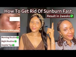 HOW TO TREAT SUNBURN FAST/how to get rid of sunburn fast on face, how to avoid sunburn. #clearskin