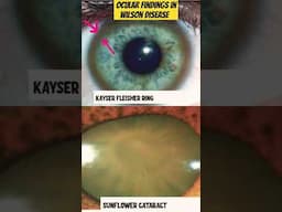 Kayser Fleisher ring and sunflower cataract